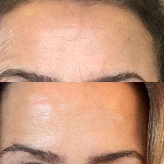 Clear skin after using L'abu Super face moisturizer