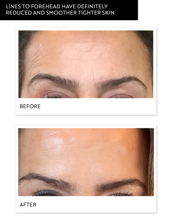 hydra-gel-mask-before-after-