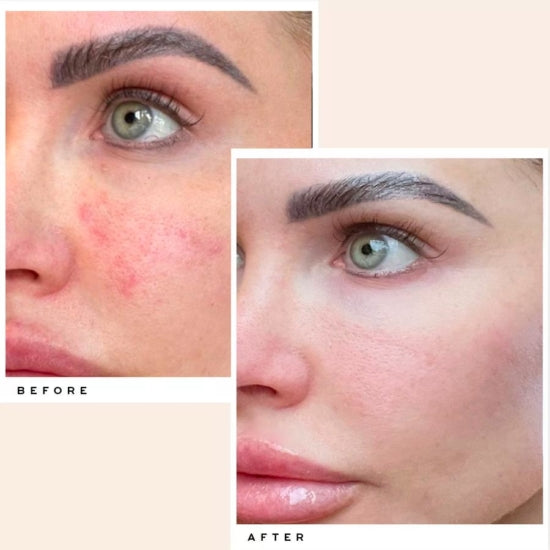 hydra-gel-mask-before-after