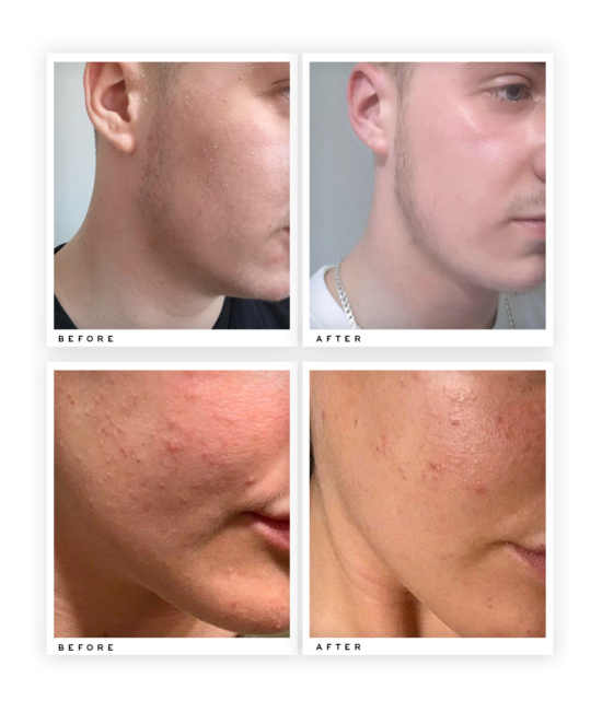 Collagen Boosting Moisturiser before and after use